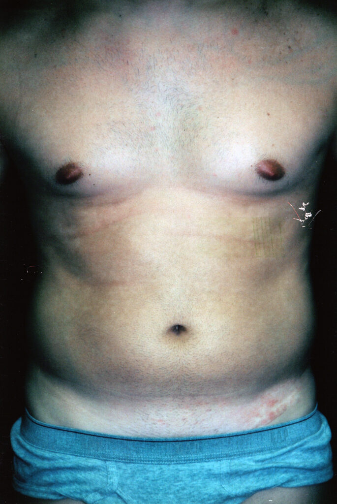 Before Image: Liposuction - front