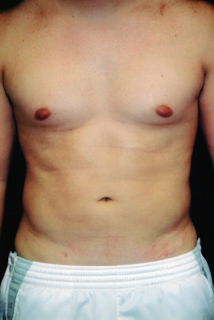 After Image: Liposuction - front