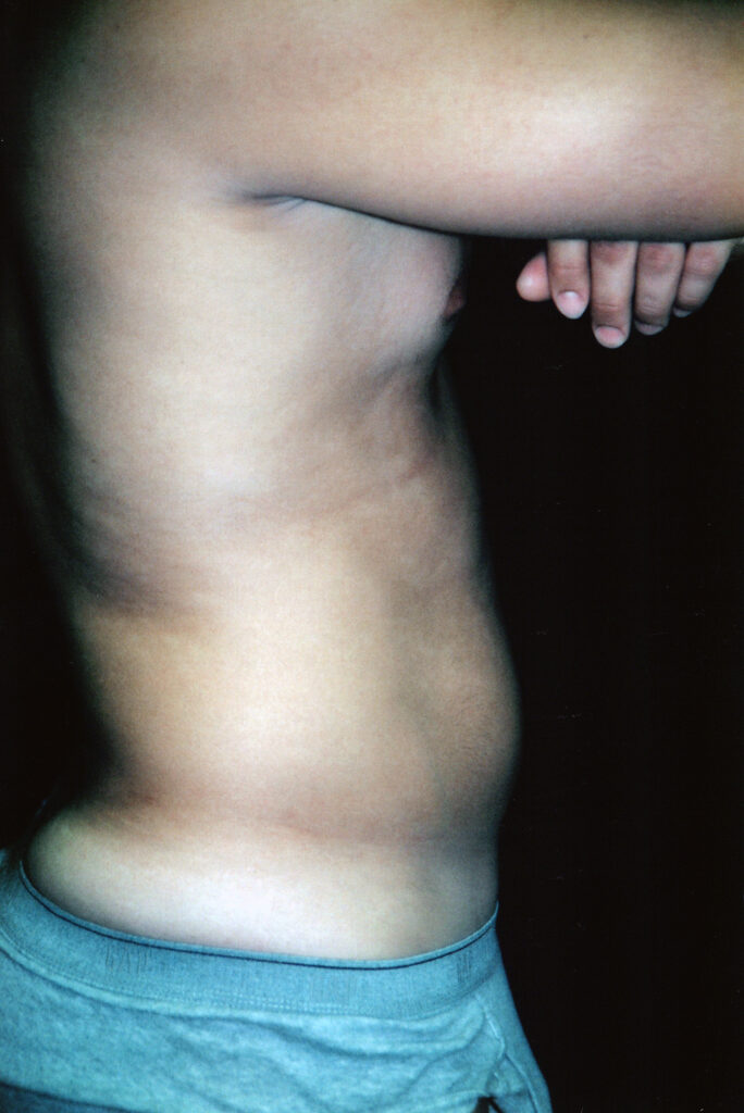 Before Image: Liposuction - right-side