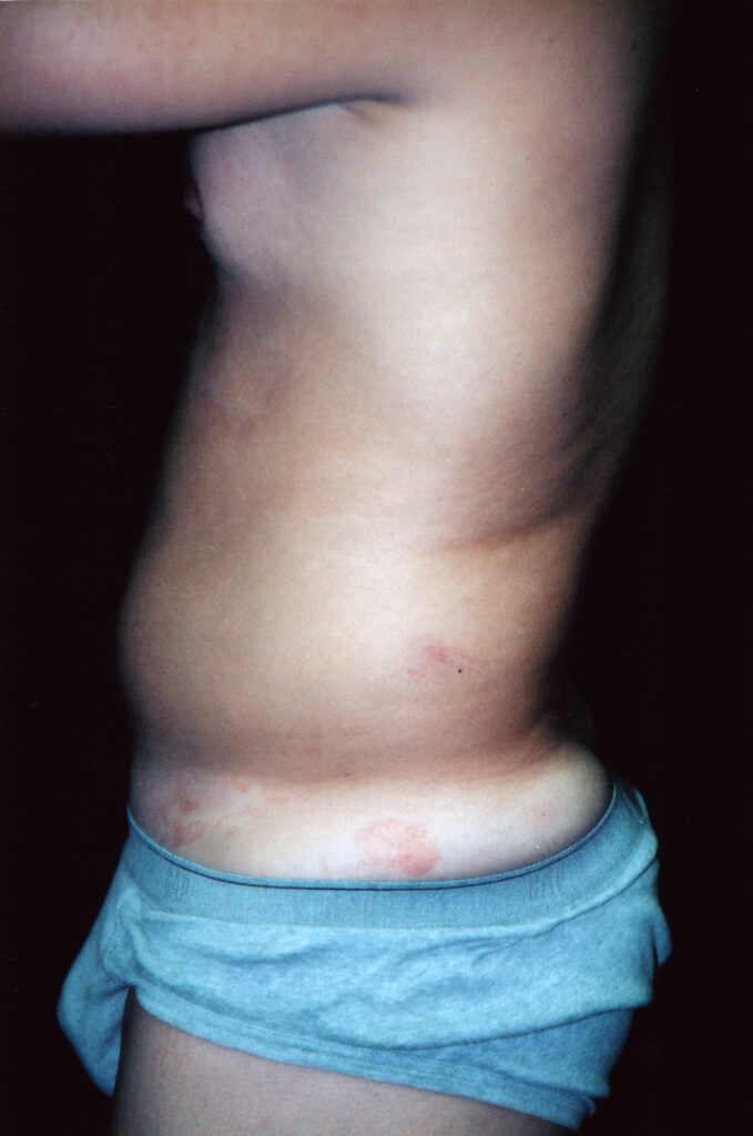 Before Image: Liposuction - left-side