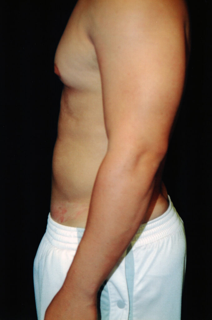After Image: Liposuction - left-side