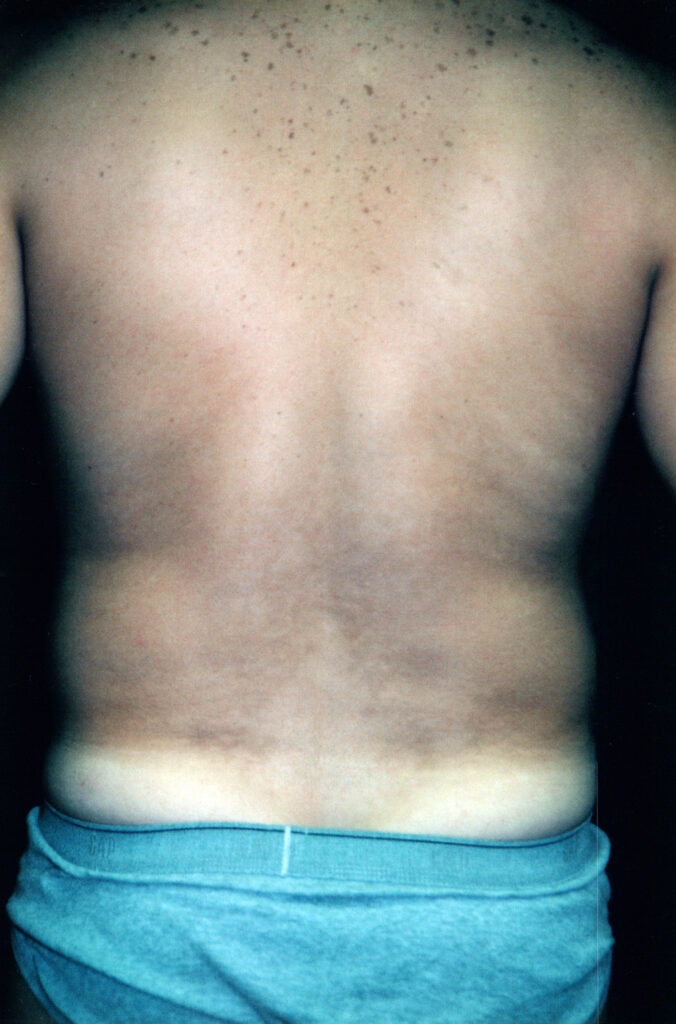 Before Image: Liposuction - back