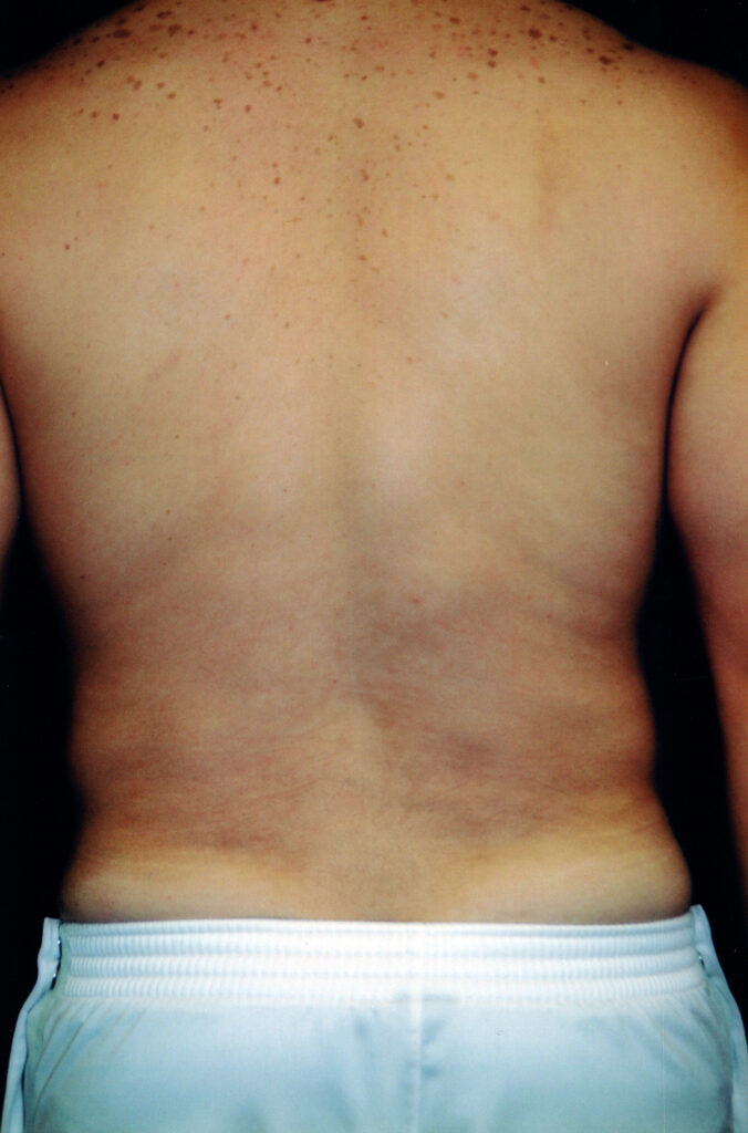 After Image: Liposuction - back