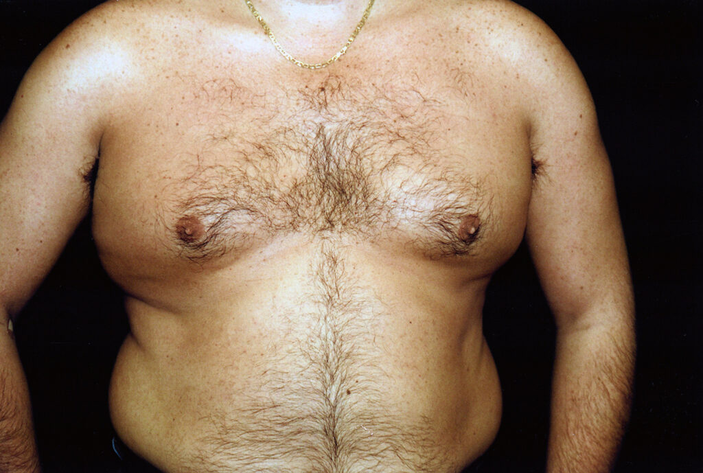 Before Image: Liposuction - front