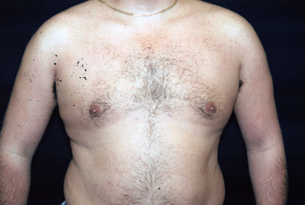After Image: Liposuction - front