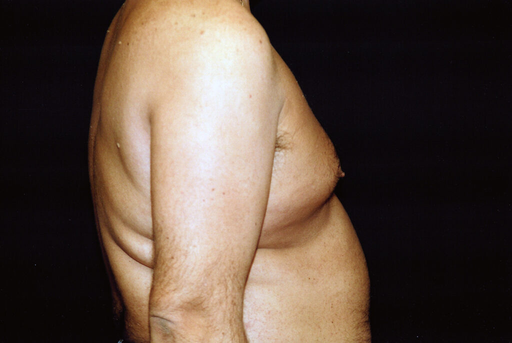 Before Image: Liposuction - right-side