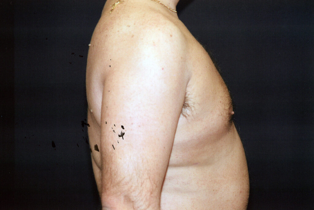 After Image: Liposuction - right-side