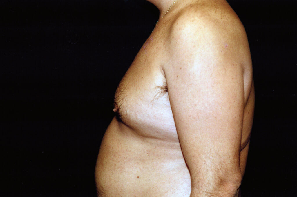 Before Image: Liposuction - left-side
