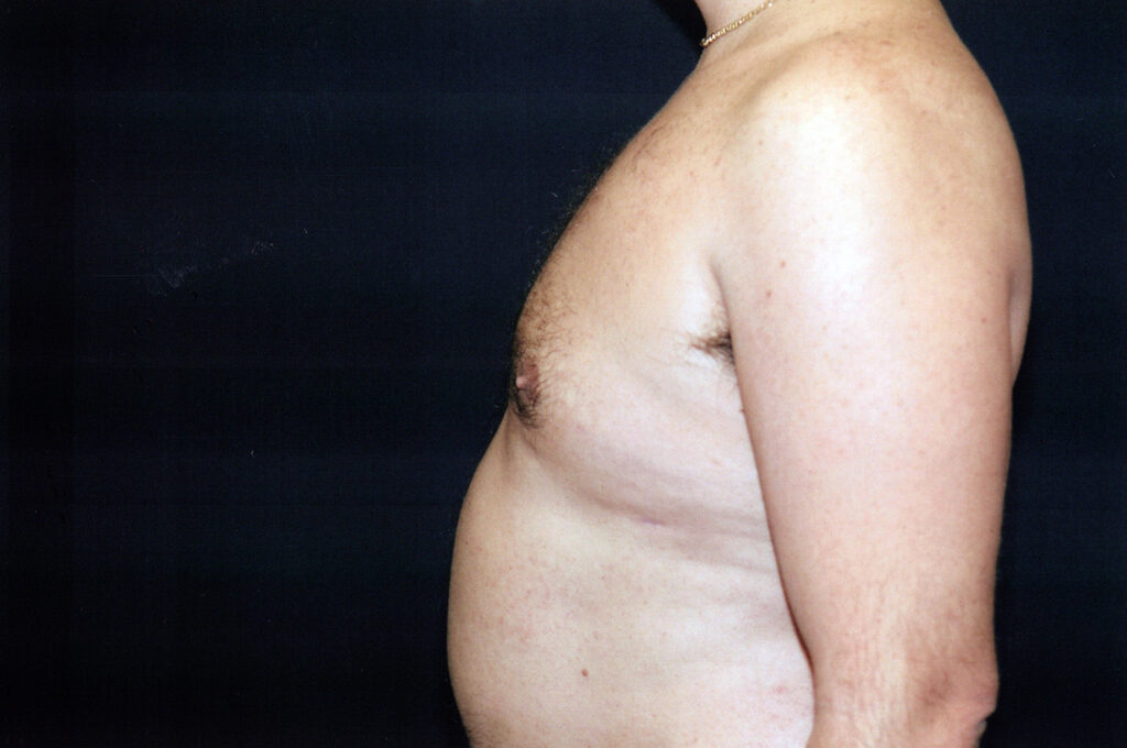 After Image: Liposuction - left-side