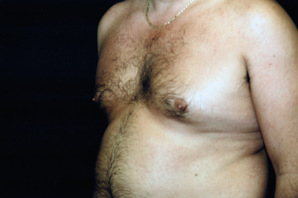 Before Image: Liposuction - left-front-oblique
