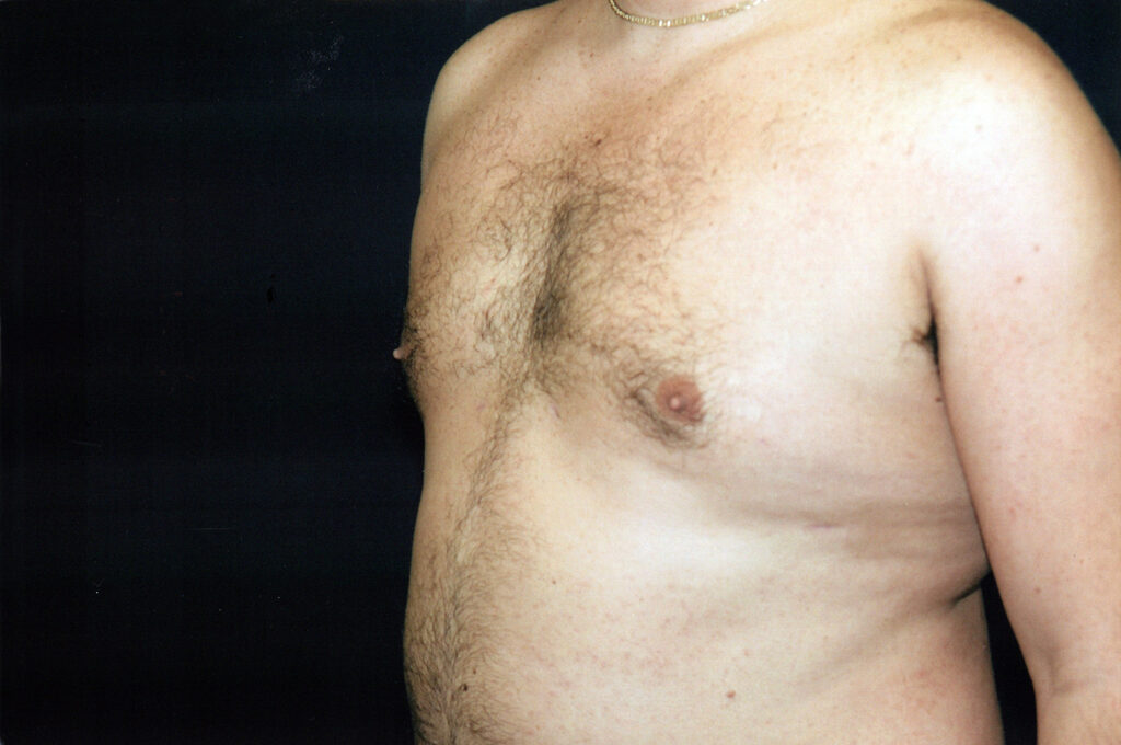 After Image: Liposuction - left-front-oblique