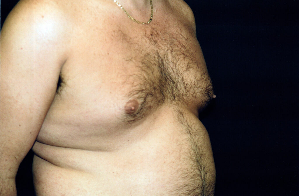Before Image: Liposuction - right-front-oblique