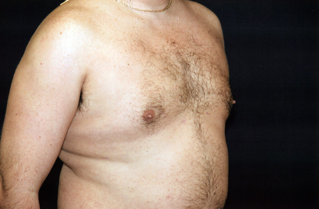 After Image: Liposuction - right-front-oblique
