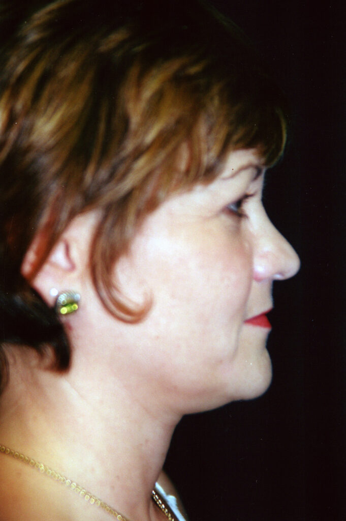 Before Image: Neck Liposuction - right-side