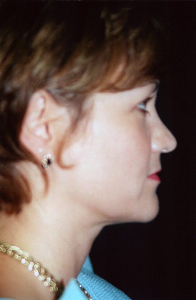 After Image: Neck Liposuction - right-side