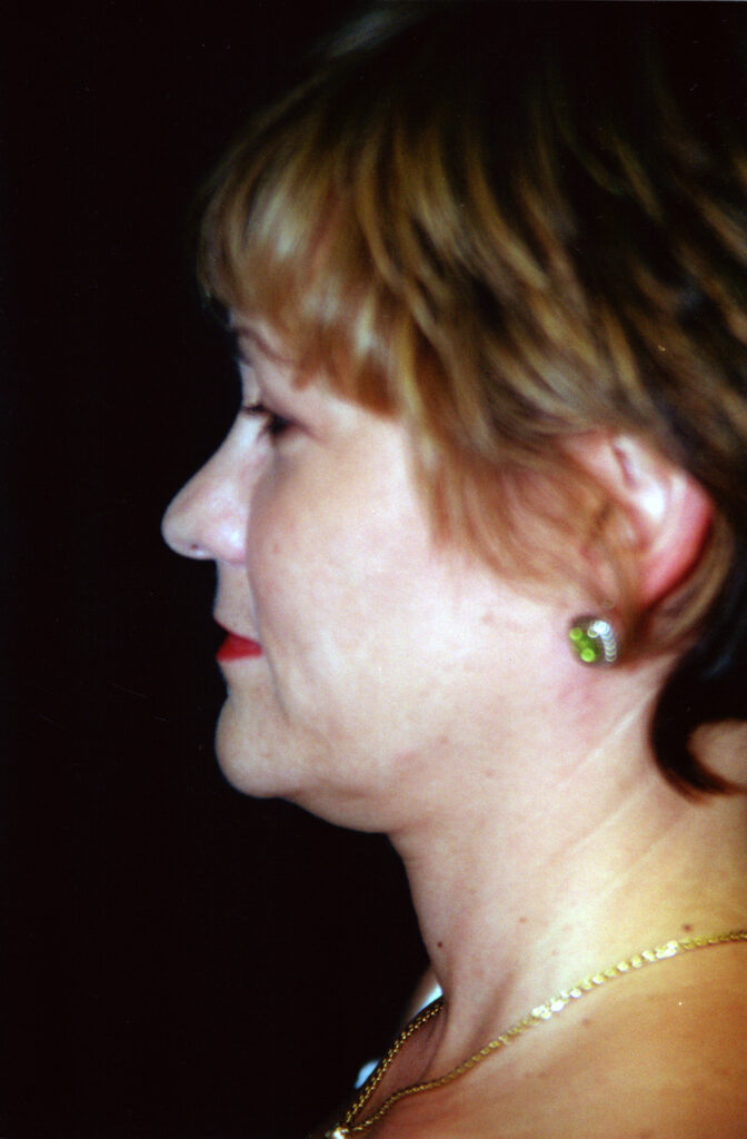 Before Image: Neck Liposuction - left-side