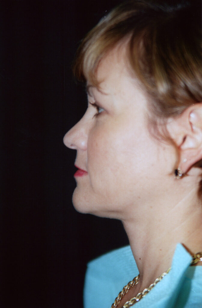 After Image: Neck Liposuction - left-side