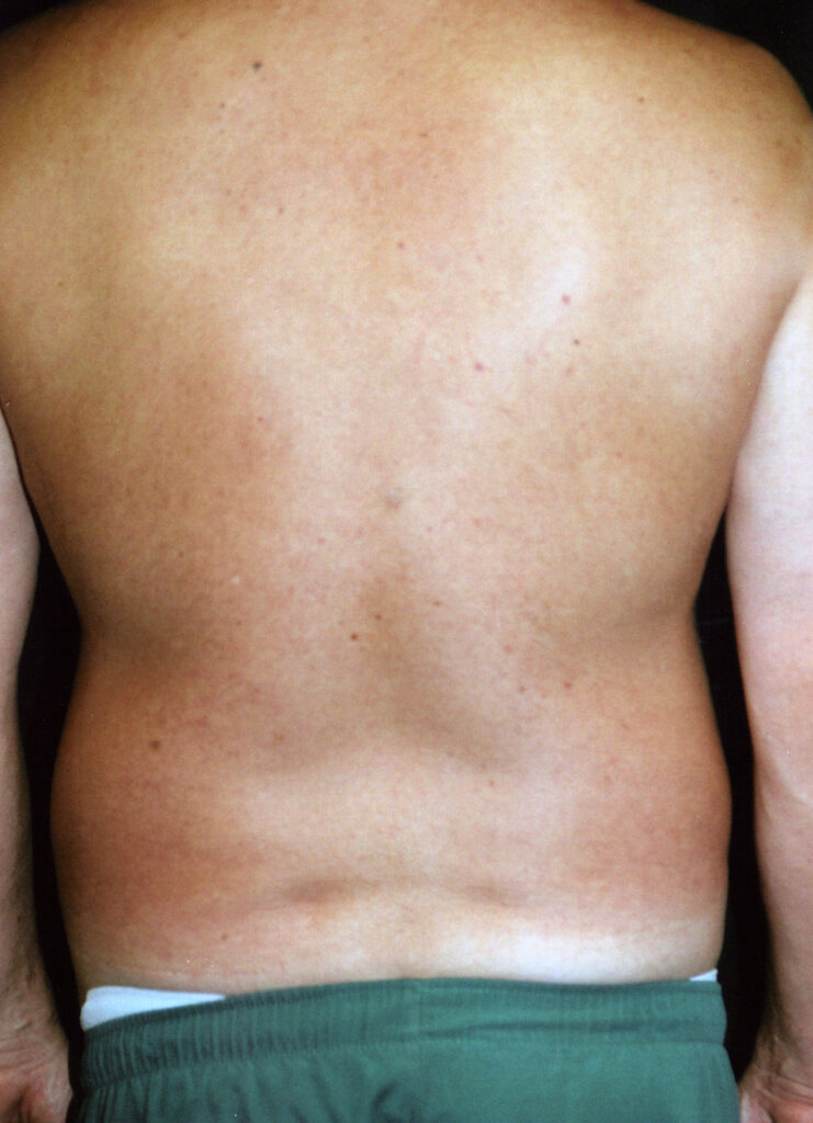 Before Image: Liposuction - back