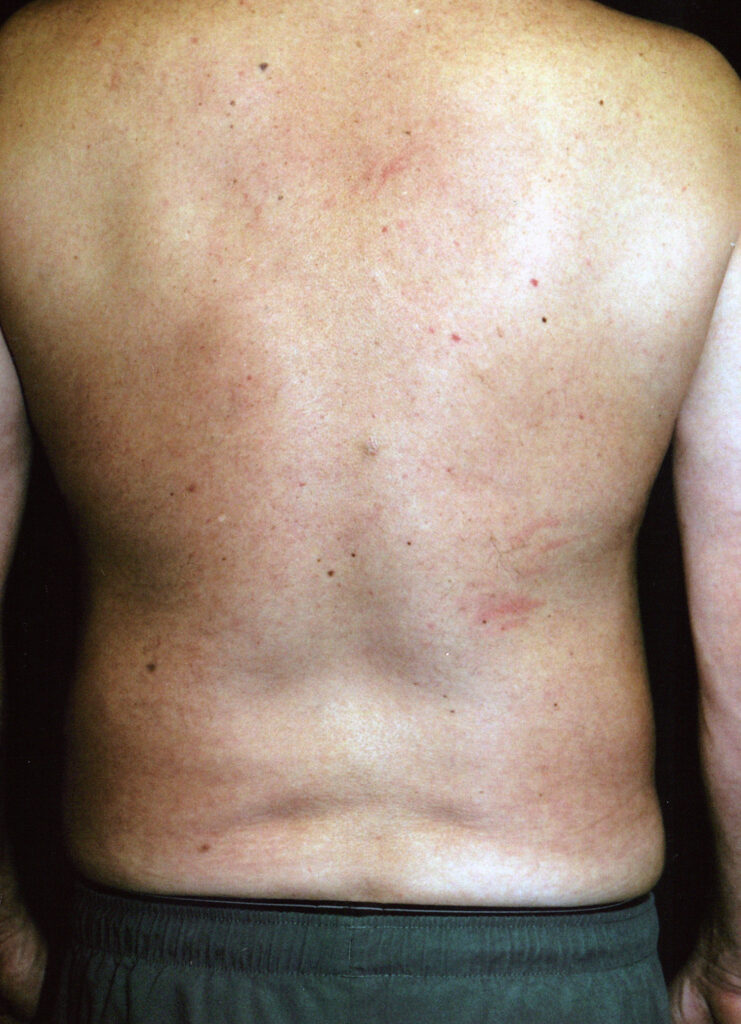 After Image: Liposuction - back