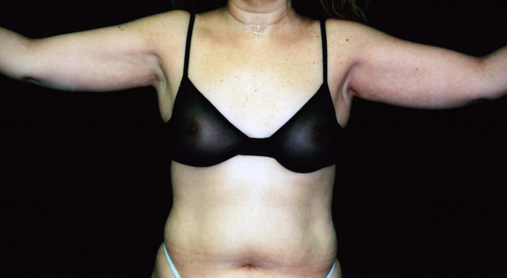 Before Image: Liposuction - front
