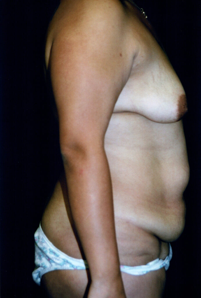 Before Image: Mommy Makeover - right-side