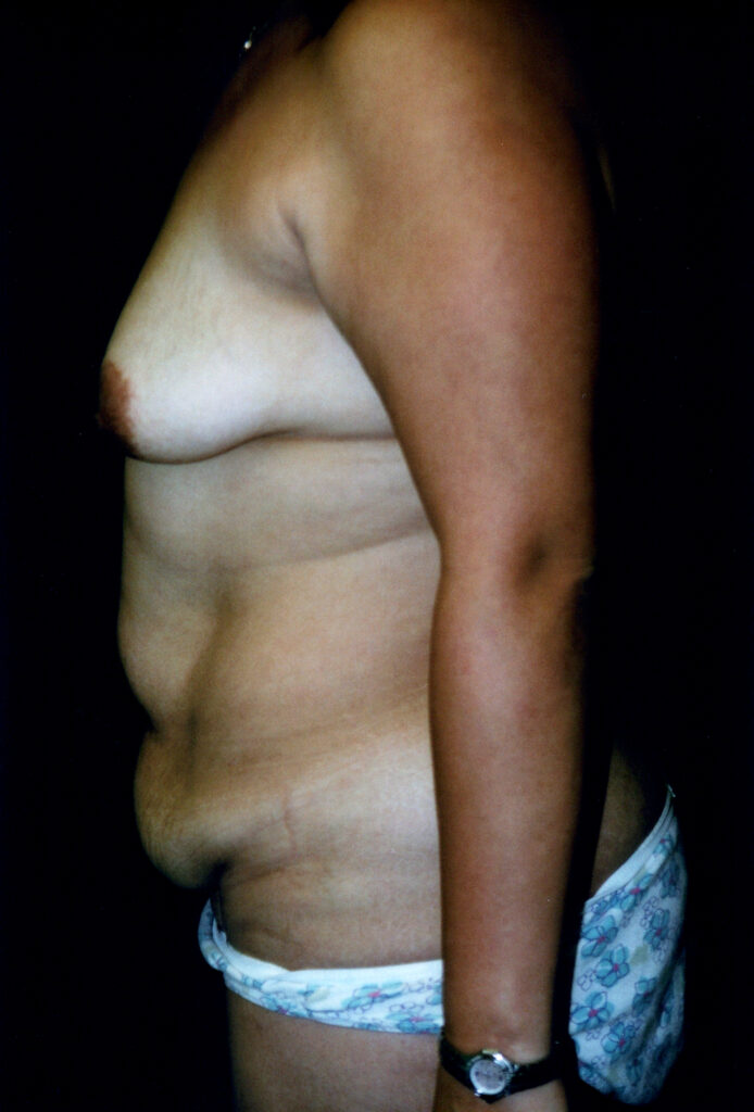 Before Image: Mommy Makeover - left-side