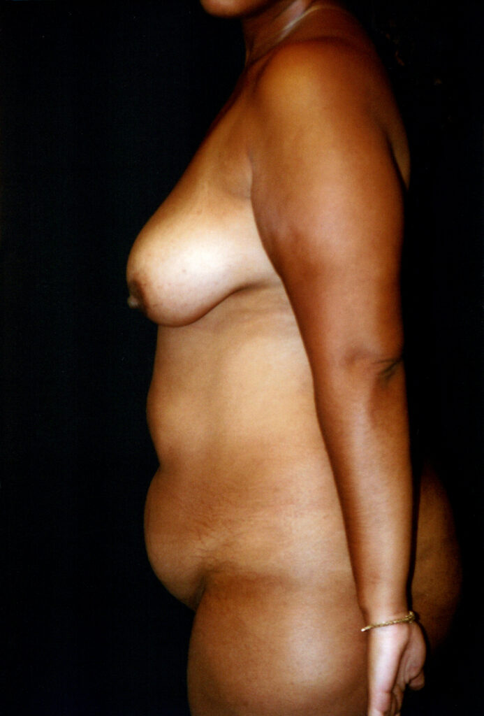 Before Image: Mommy Makeover - left-side