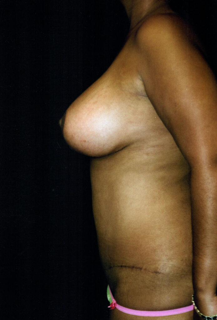 After Image: Mommy Makeover - left-side