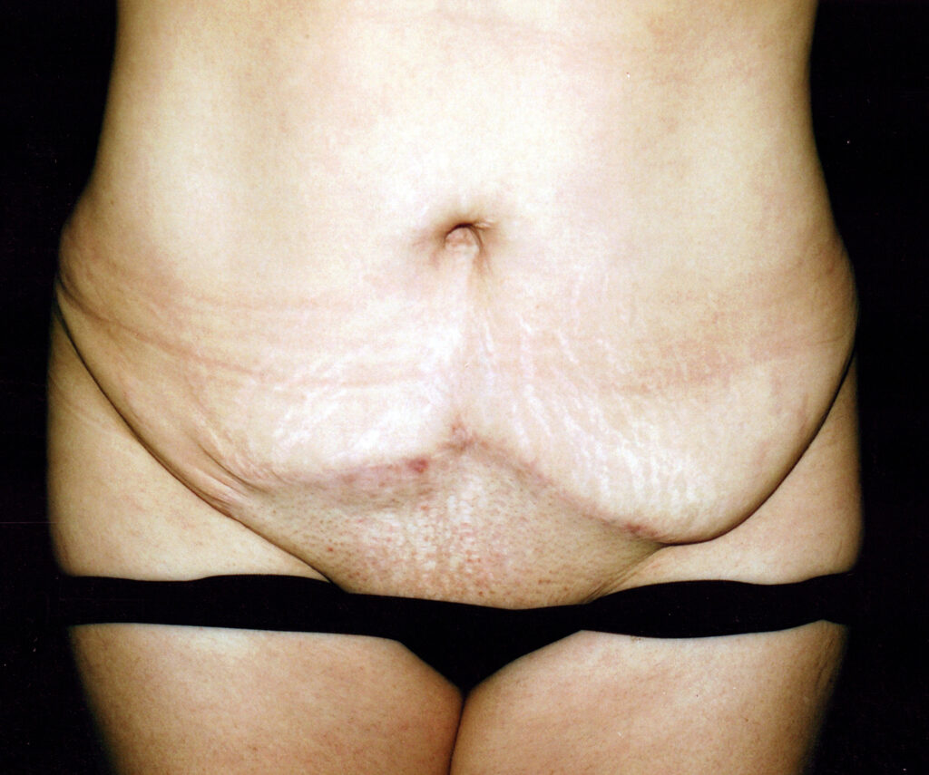 Before Image: Mommy Makeover - front