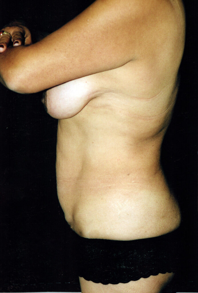 Before Image: Mommy Makeover - left-side