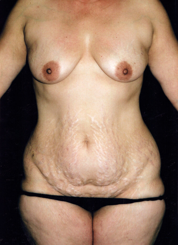 Before Image: Mommy Makeover - front