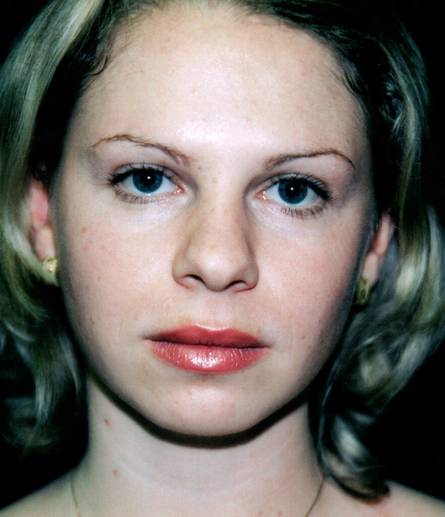 Before Image: Rhinoplasty - front
