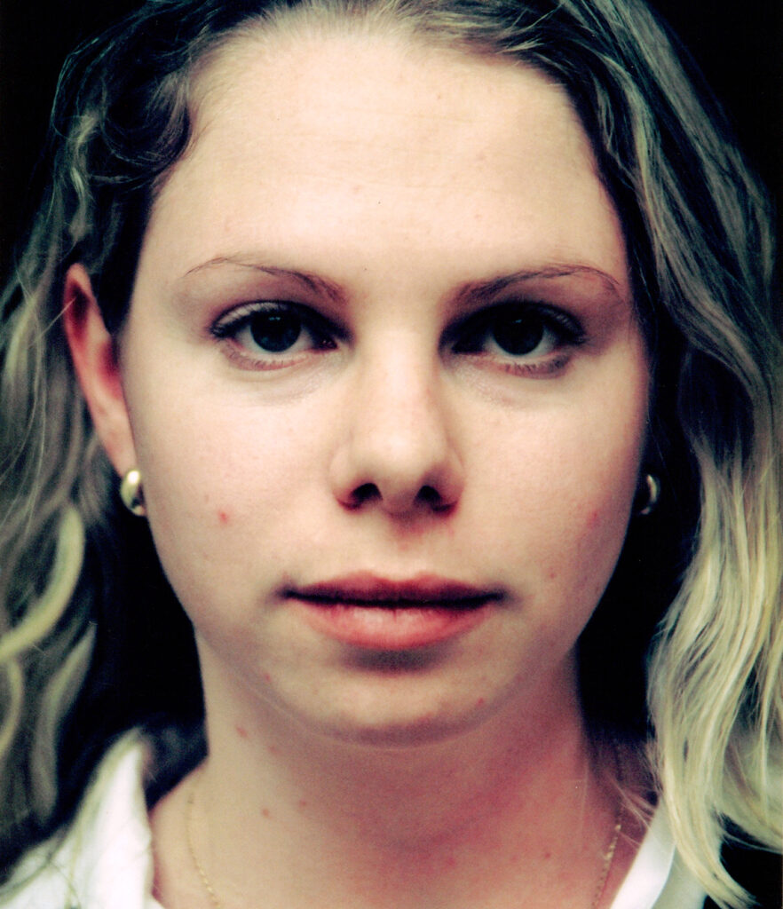 After Image: Rhinoplasty - front