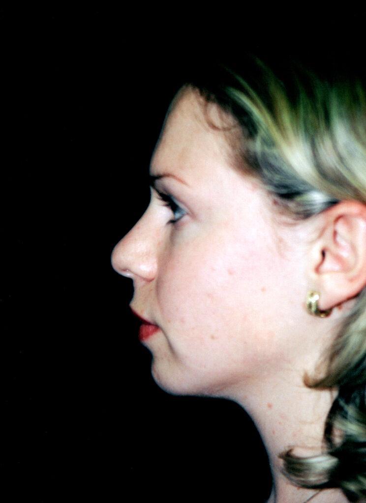 Before Image: Rhinoplasty - left-side