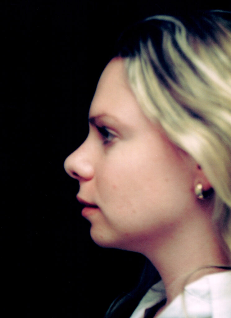 After Image: Rhinoplasty - left-side