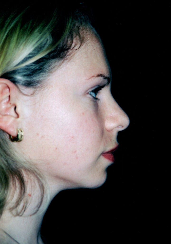 Before Image: Rhinoplasty - right-side