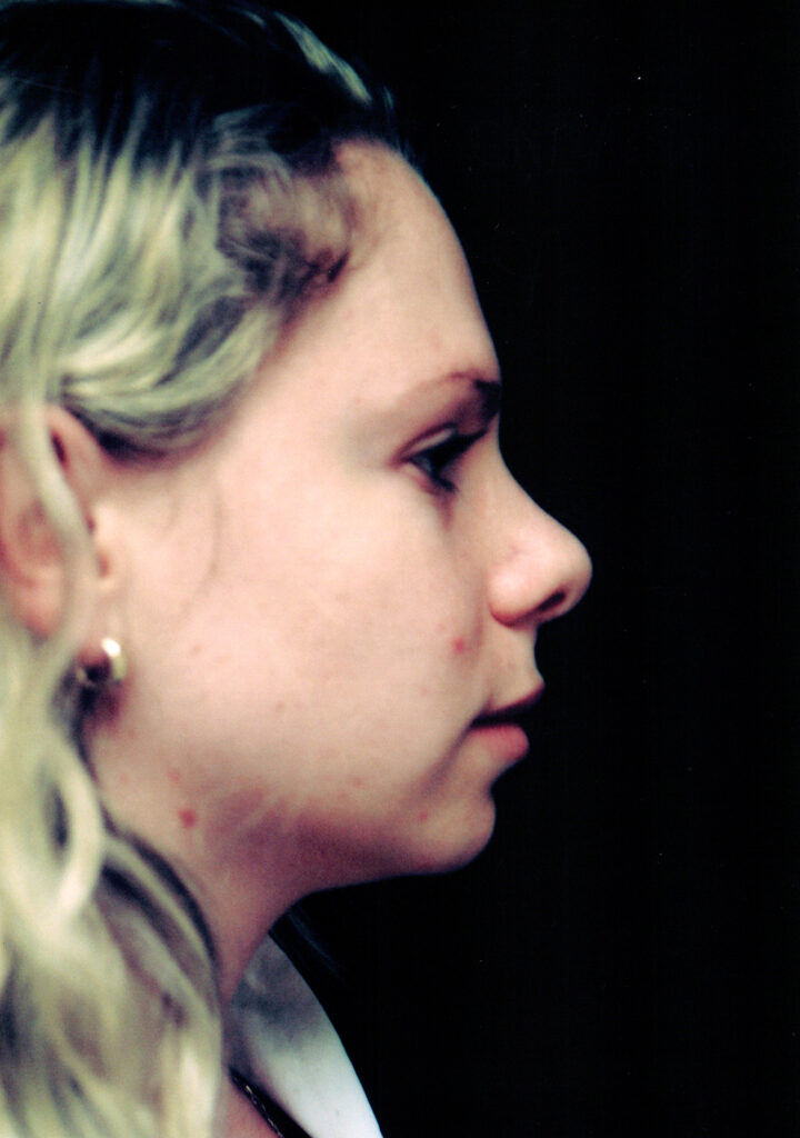 After Image: Rhinoplasty - right-side