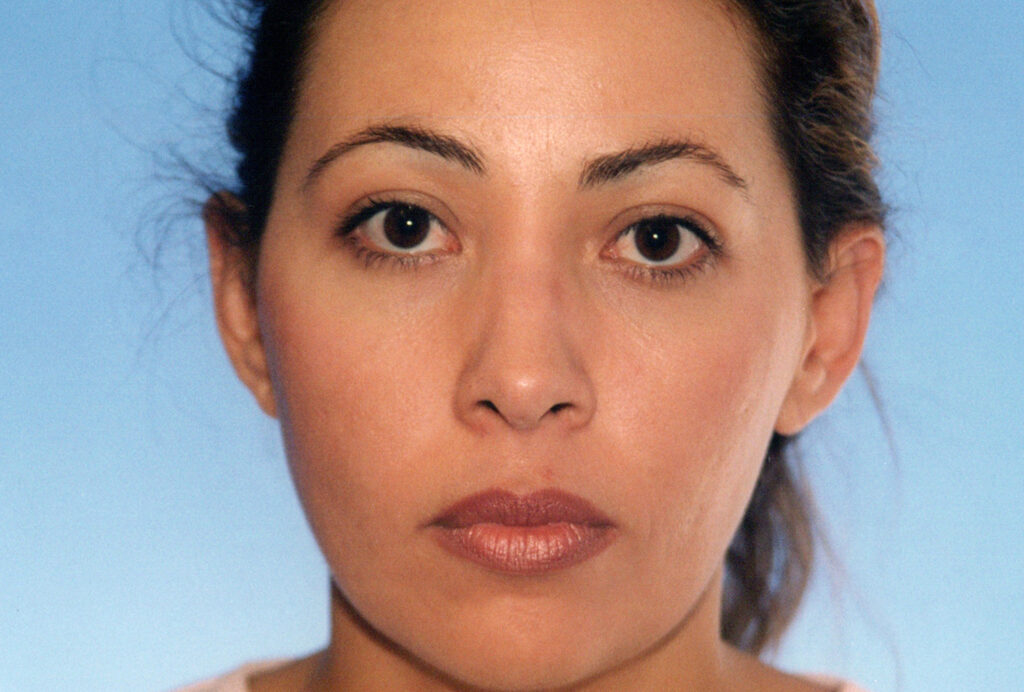 Before Image: Rhinoplasty - front