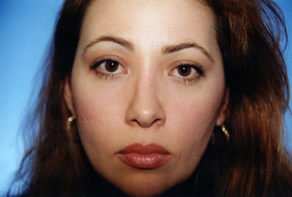 After Image: Rhinoplasty - front