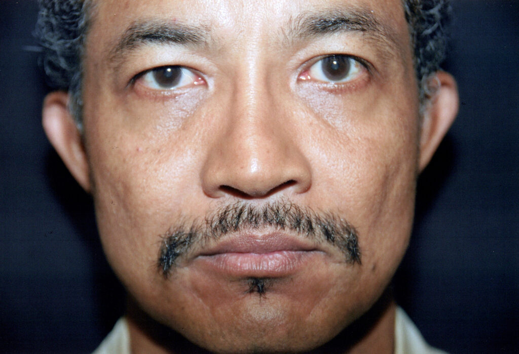 Before Image: Rhinoplasty - front