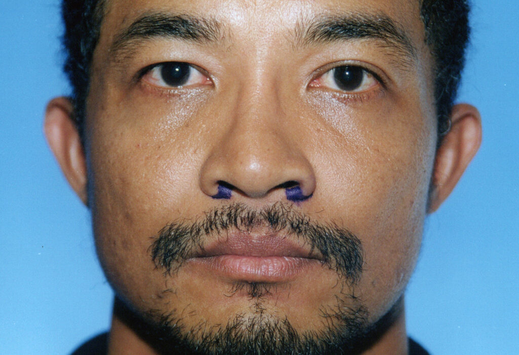 After Image: Rhinoplasty - front