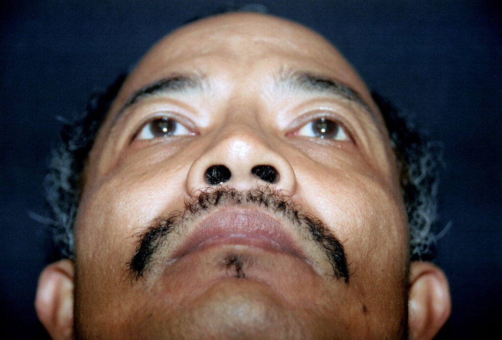 Before Image: Rhinoplasty - front