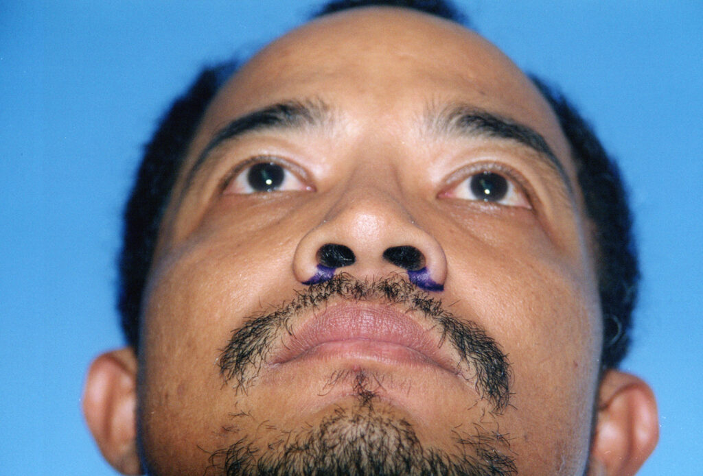 After Image: Rhinoplasty - front