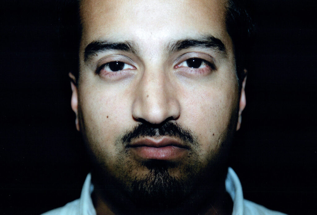 Before Image: Rhinoplasty - front