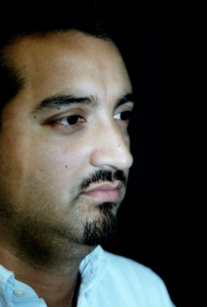Before Image: Rhinoplasty - right-front-oblique