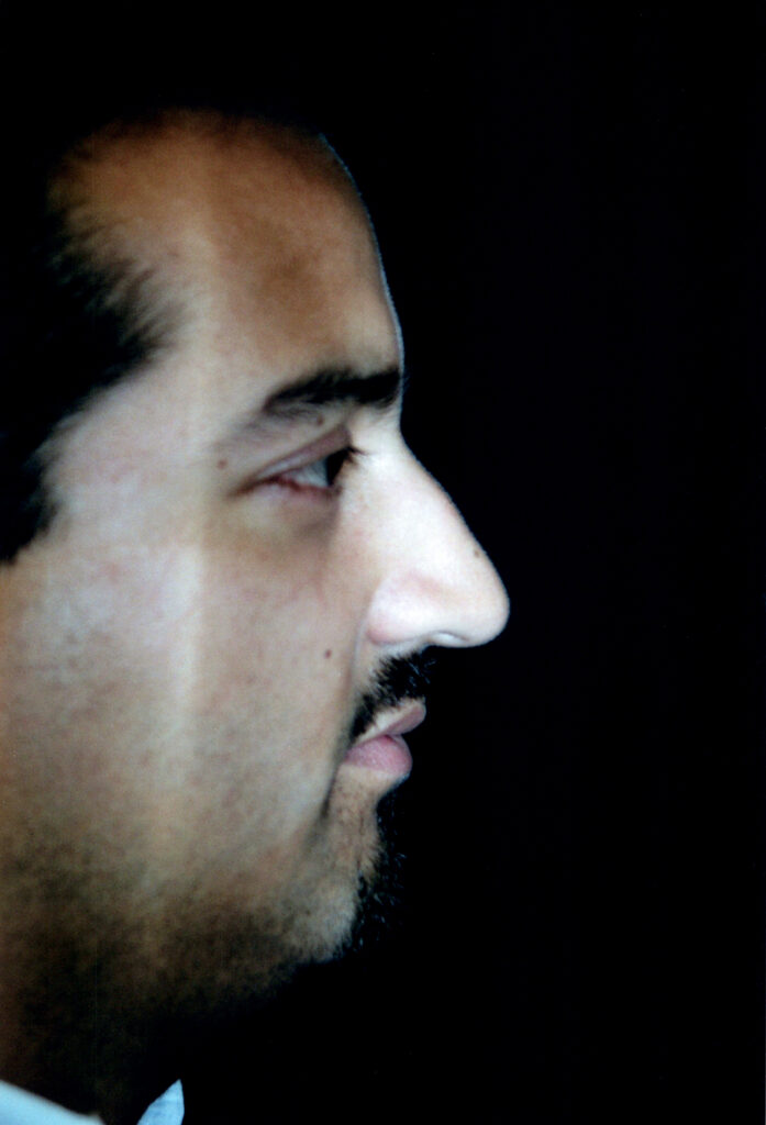 Before Image: Rhinoplasty - right-side