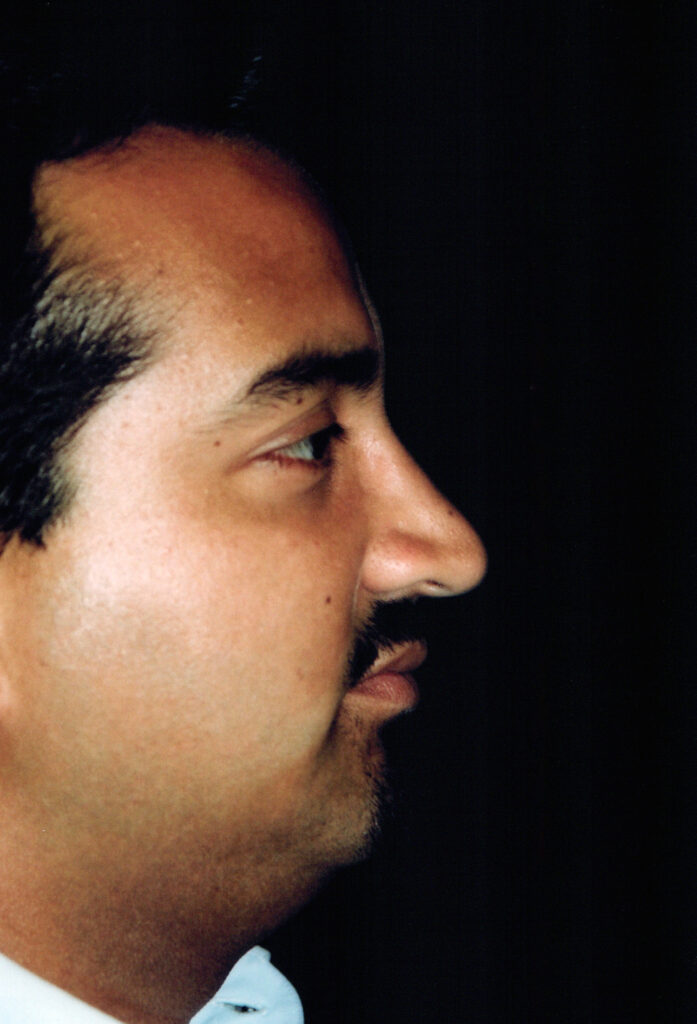 After Image: Rhinoplasty - right-side