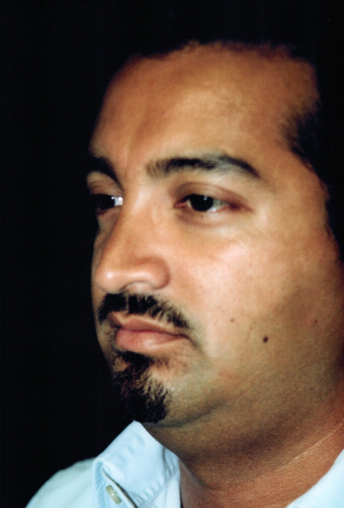 After Image: Rhinoplasty - left-front-oblique