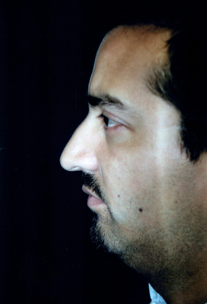 Before Image: Rhinoplasty - left-side