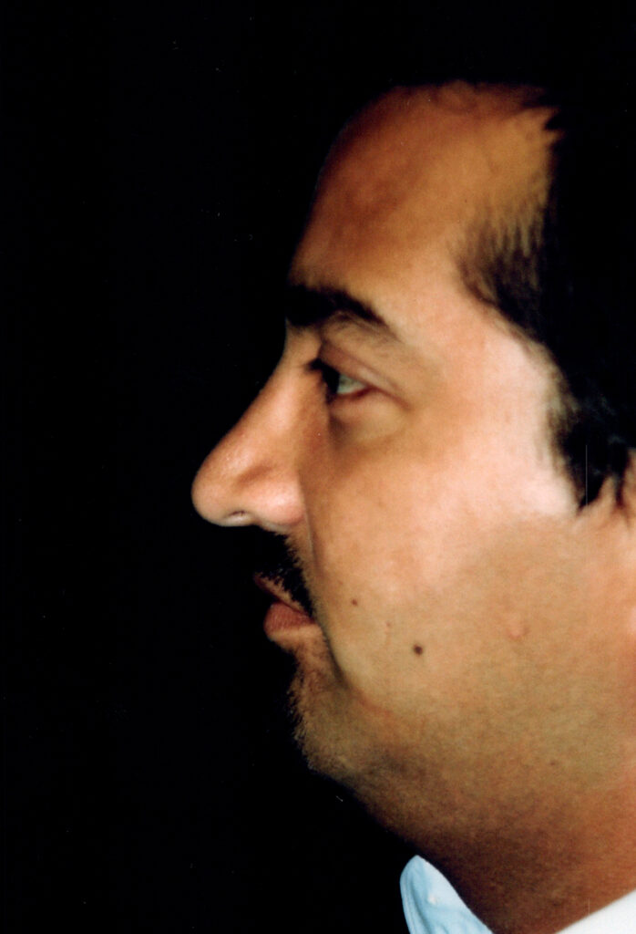After Image: Rhinoplasty - left-side